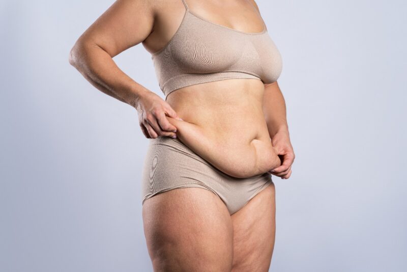 Kõhuplastika (abdominoplastika, rippuva kõhunaha plastika)